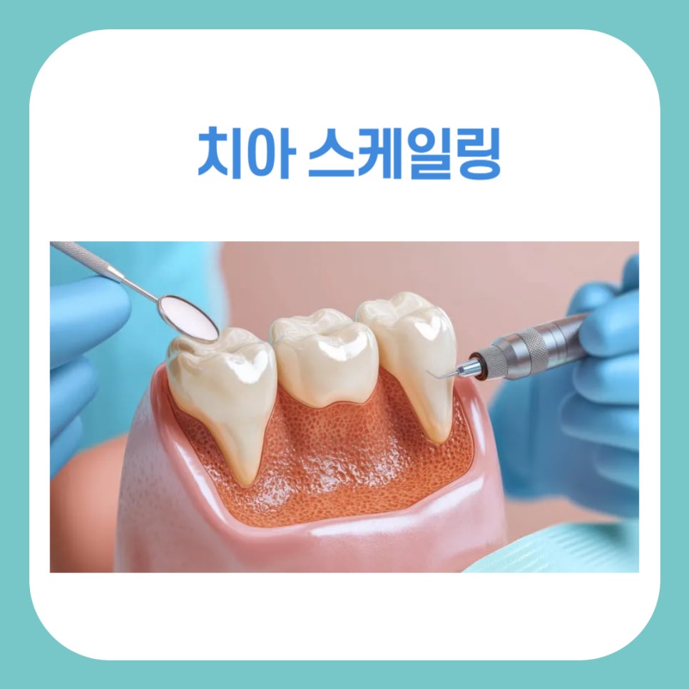 치아 스케일링 주기, 비용, 보험적용 관련 이미지 1