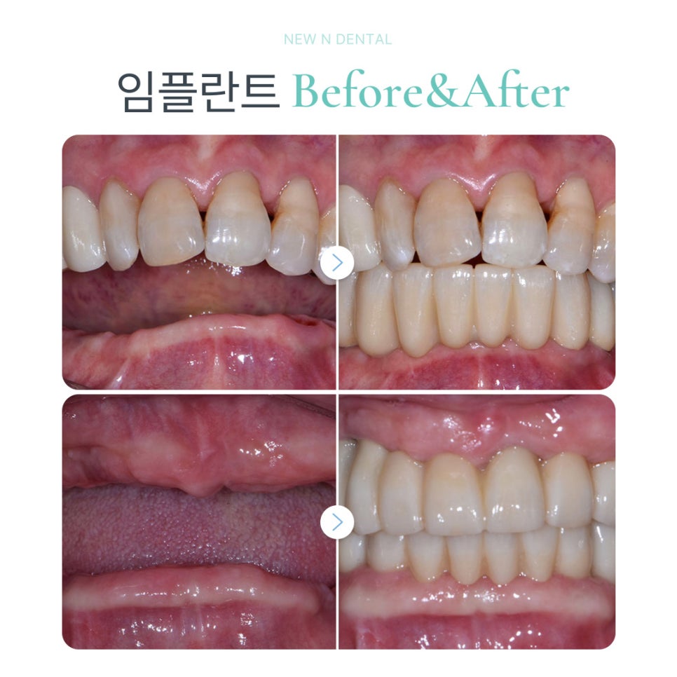 강남임플란트잘하는곳 선택 기준 및 진료 환경 관련 이미지 10