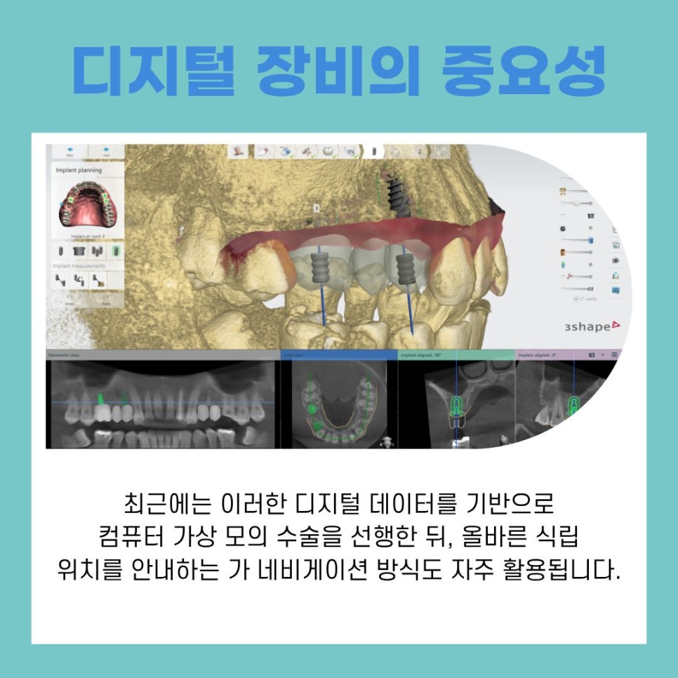 Understanding the Treatment Process at a Gangnam Station Implant Dental Clinic image 8