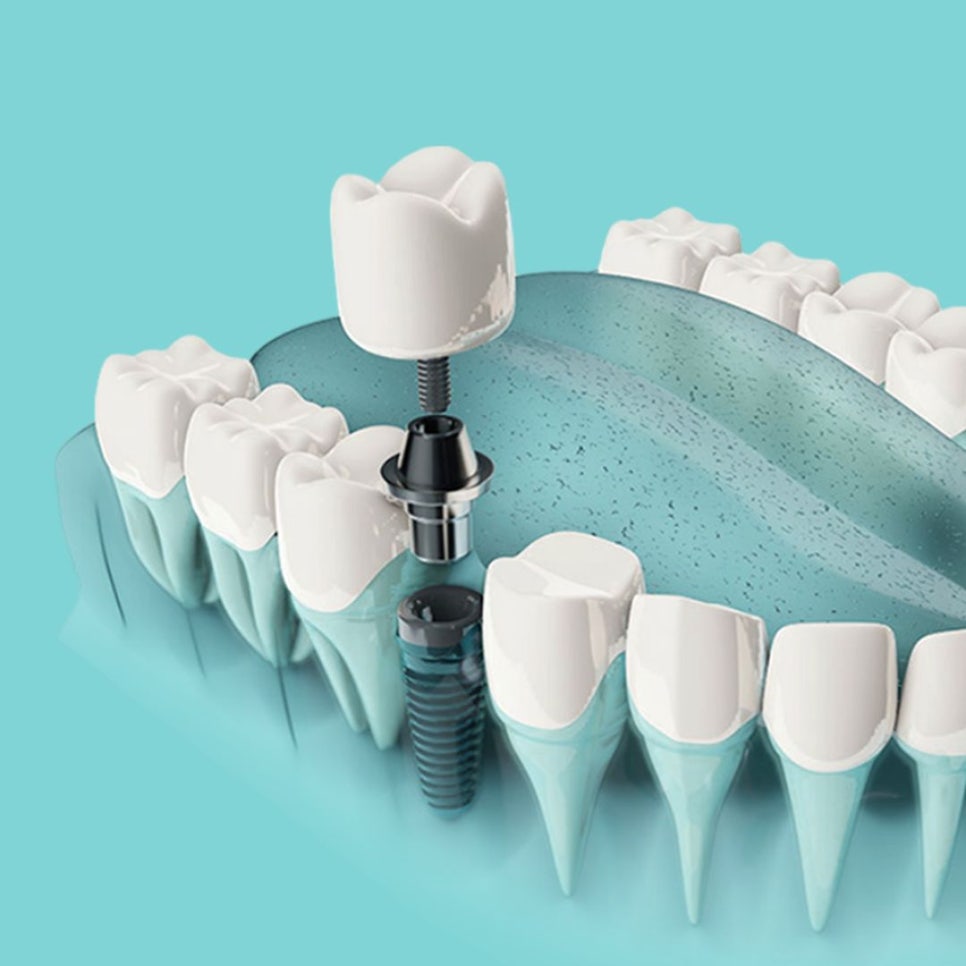 Understanding the Treatment Process at a Gangnam Station Implant Dental Clinic image 2