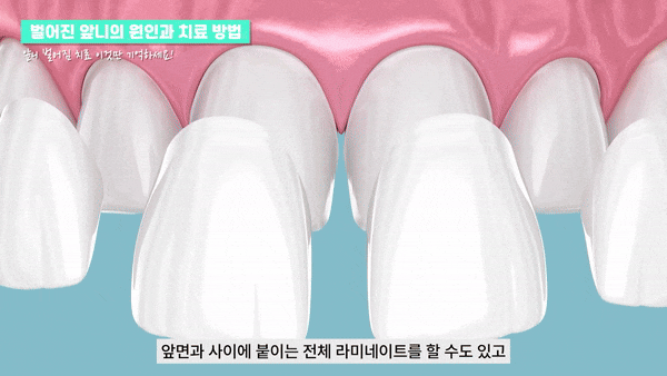 강남역라미네이트 환한 인상을 위한 관리 관련 이미지 7