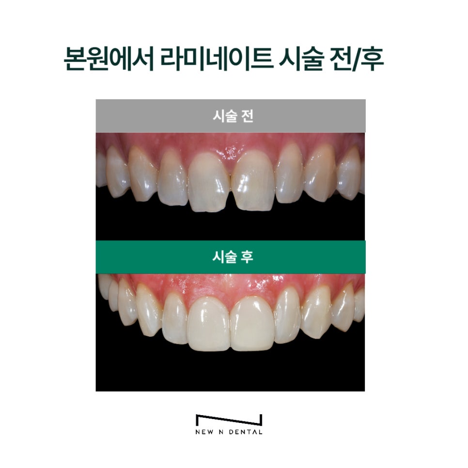Non-Prep Veneer Cost at a Dental Clinic Near Sinnonhyeon Station image 8