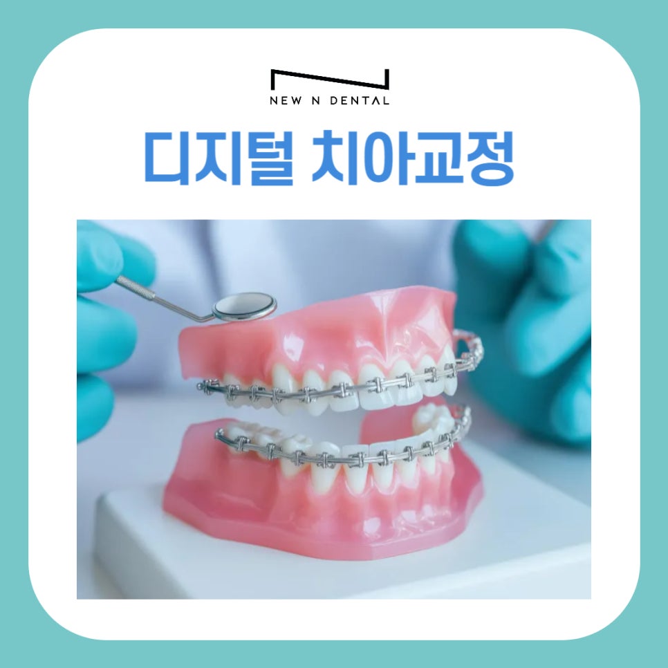디지털 장비를 이용한 맞춤 치아 교정 관련 이미지 2