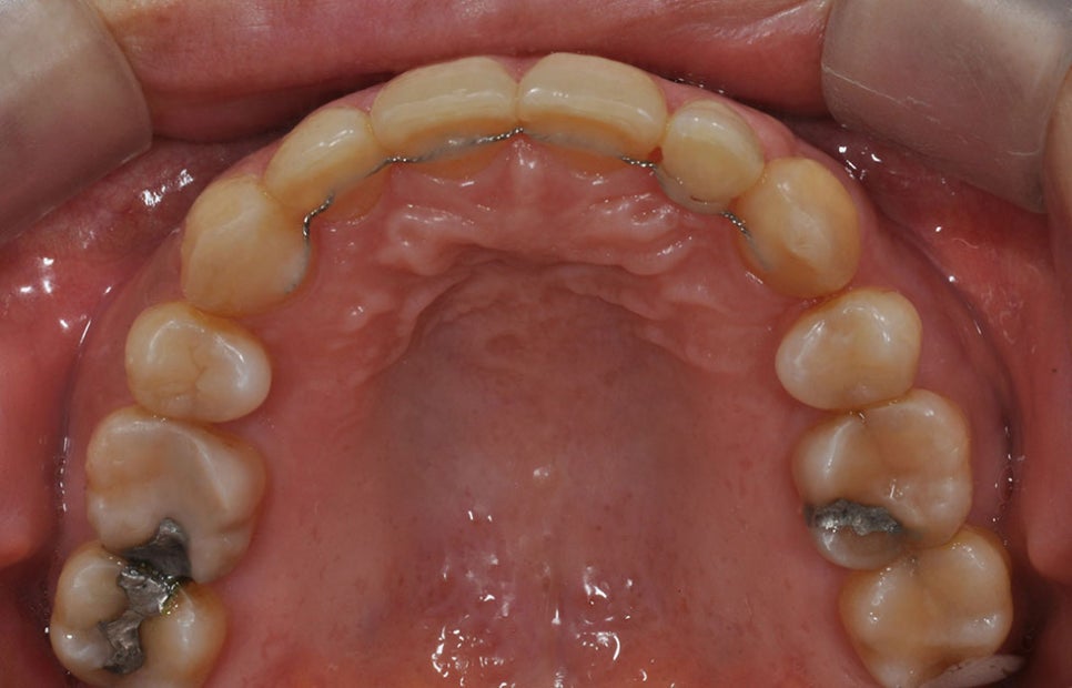 서초동치아교정잘하는곳 미세하고 우수하게 관련 이미지 5