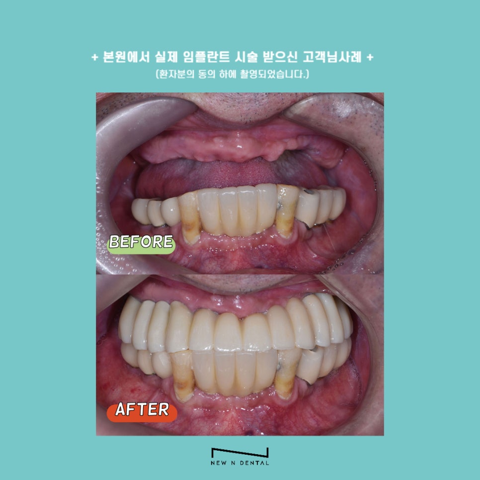 강남역임플란트 오래쓰는 뉴엔치과의 전문성 관련 이미지 2