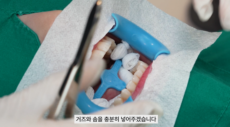강남치과 원데이치아미백 누런치아 탈출 관련 이미지 7