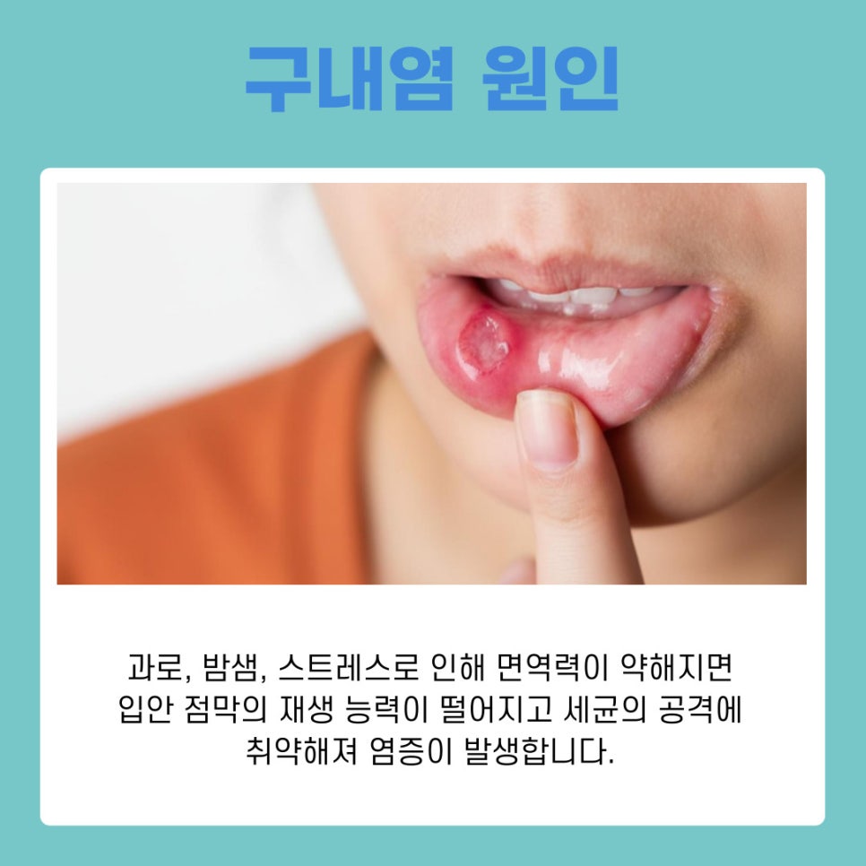 The Cause of Stomatitis: The Unwelcome Guest in Your Mouth Brought on by Fatigue and Nutritional Imbalance image 6