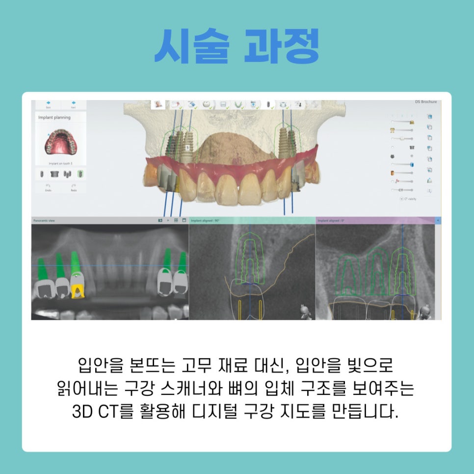 서초 임플란트치과 통증은 줄이고 정확도는 높이는 네비게이션 치료법 관련 이미지 7