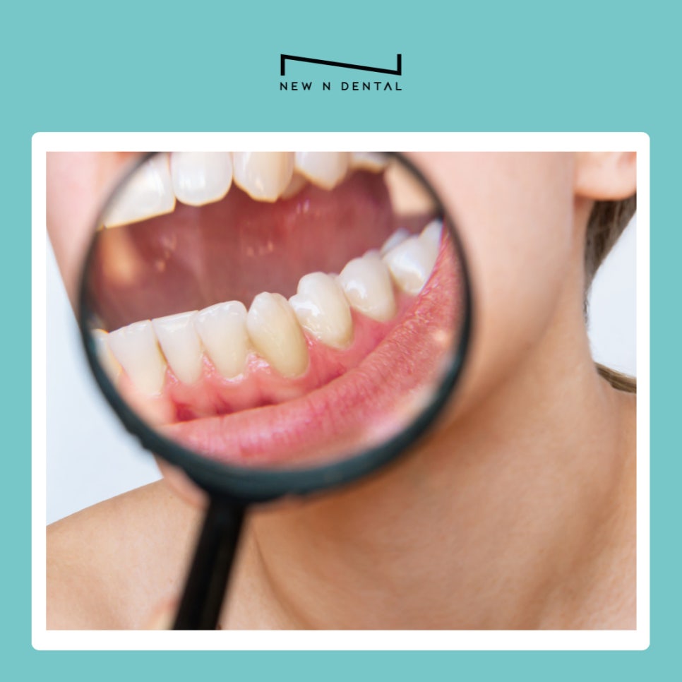 강남역 라미네이트치과 무삭제로 자연치아 지키는 법 관련 이미지 5