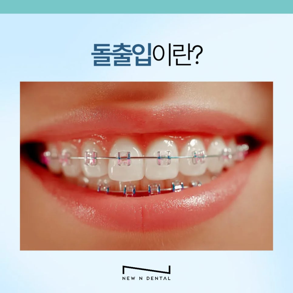 강남 돌출입치아교정 개선하려면 관련 이미지 3