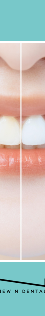 강남 무삭제 라미네이트 치아 손상 없이 예뻐지는 방법 관련 이미지 13