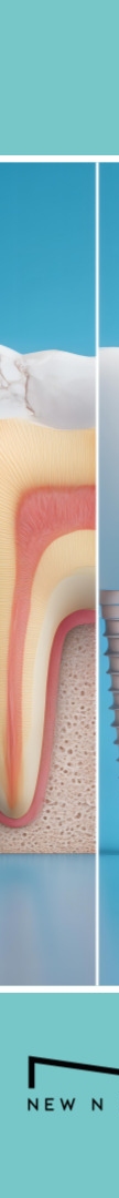 A Complete Guide to Implant Steps and Differences by Type at a Gangnam Station Dental Clinic image 13