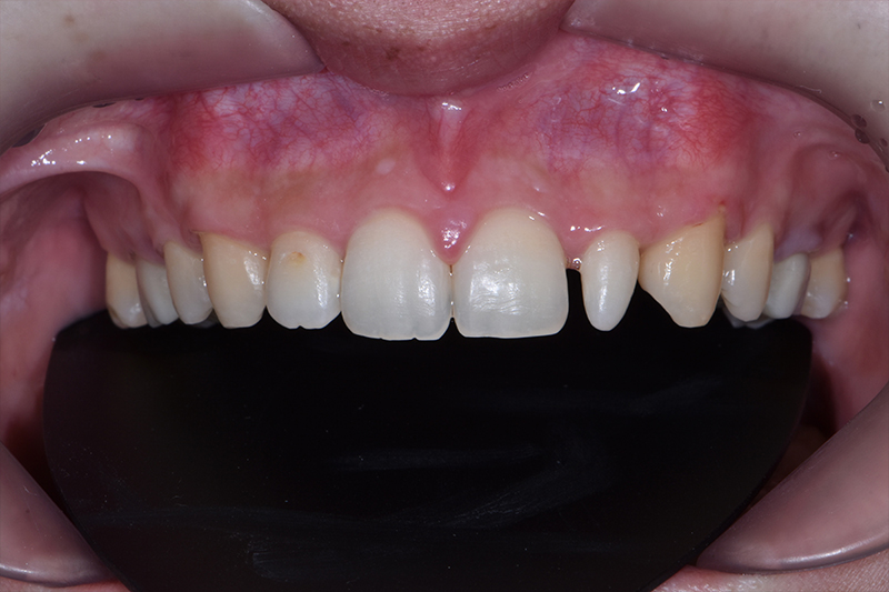 강남구치과추천 티없는 치아의 자신감 관련 이미지 4