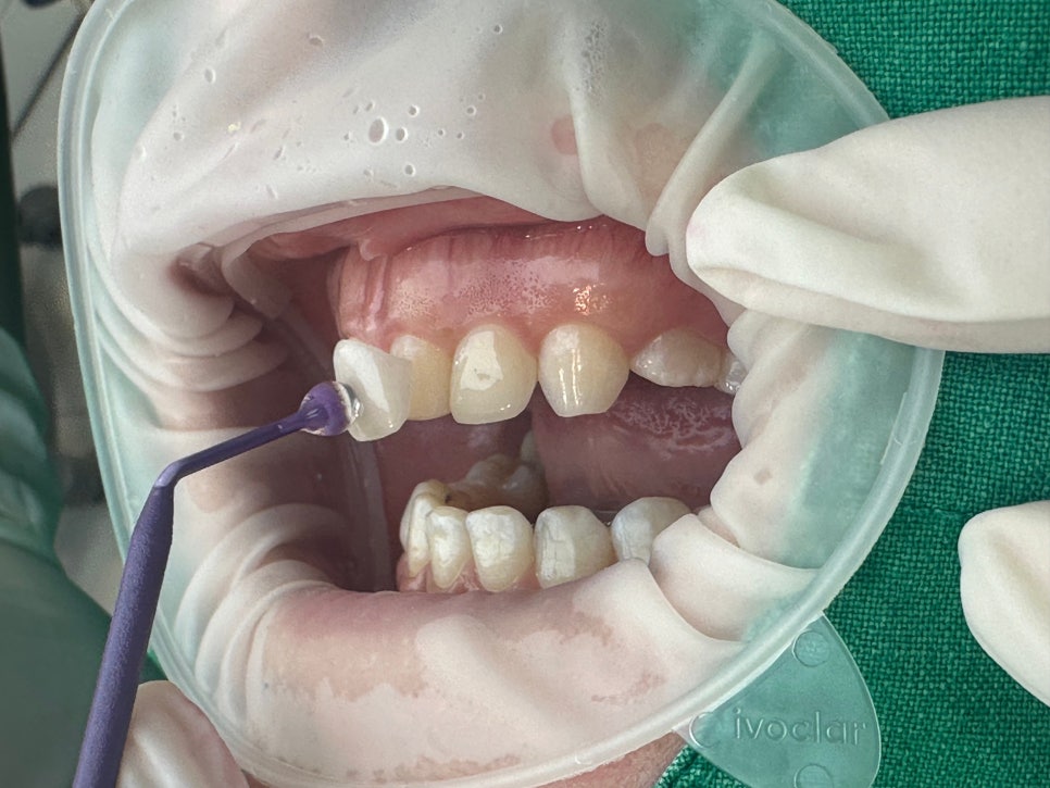 논현동라미네이트 인상이 좋아 보이도록 관련 이미지 7