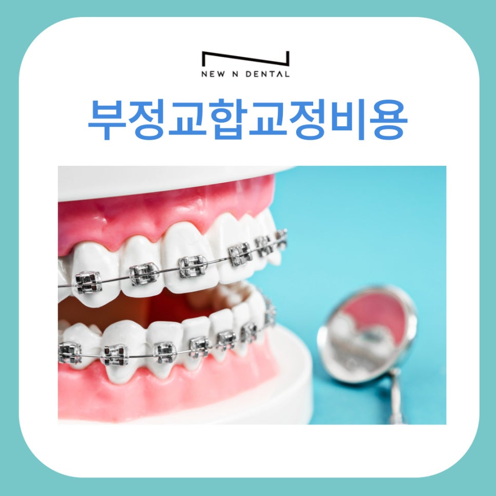 부정교합교정비용 결정 전 확인해야 할 사항 관련 이미지 1