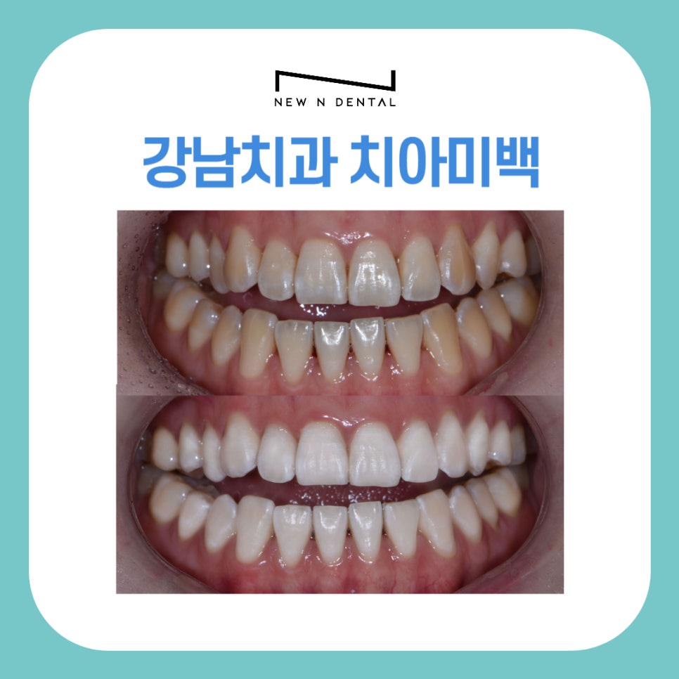 강남치과 치아미백, 누런치아 하얗게 만드는 방법은 관련 이미지 1