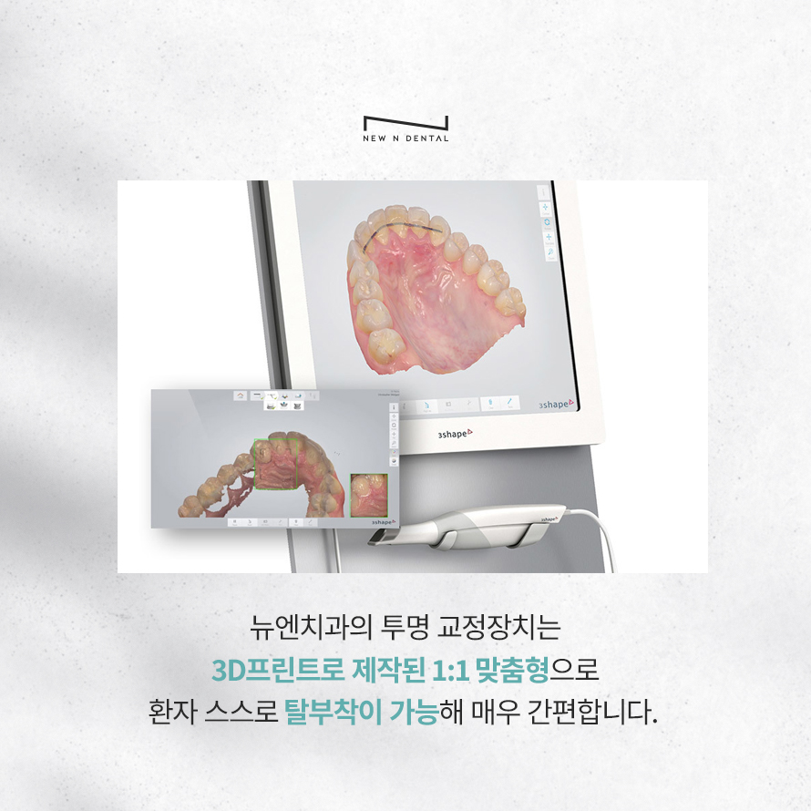 강남교정치과 티안나는 뉴엔 투명교정 관련 이미지 6