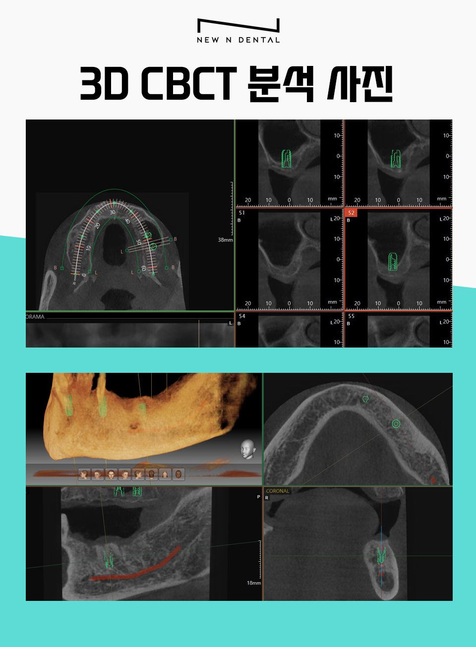 서초동임플란트치과 자연 치아가 탈락했다면 관련 이미지 3