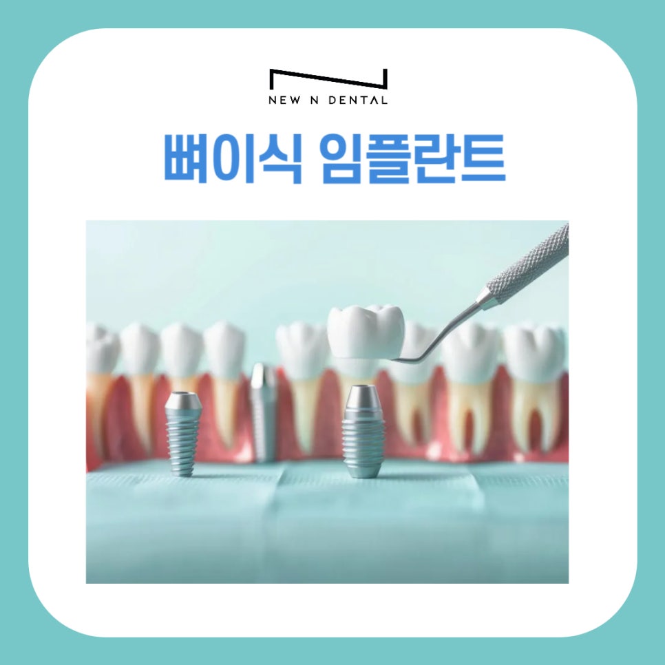 뼈이식임플란트, 잇몸뼈 부족 고민 완벽 해결 관련 이미지 1