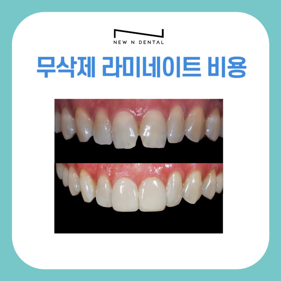 Non-Prep Veneer Cost at a Dental Clinic Near Sinnonhyeon Station image 1