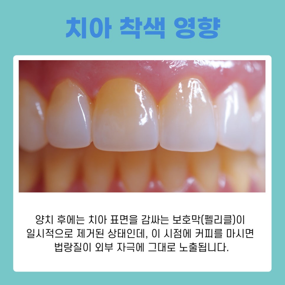 서초동 치과 양치 후 커피 치아착색 예방하는 관리법 관련 이미지 3