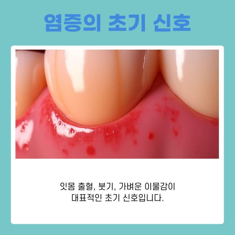 역삼동 임플란트 염증 초기 원인부터 예방법까지 한 번에 보기 관련 이미지 9