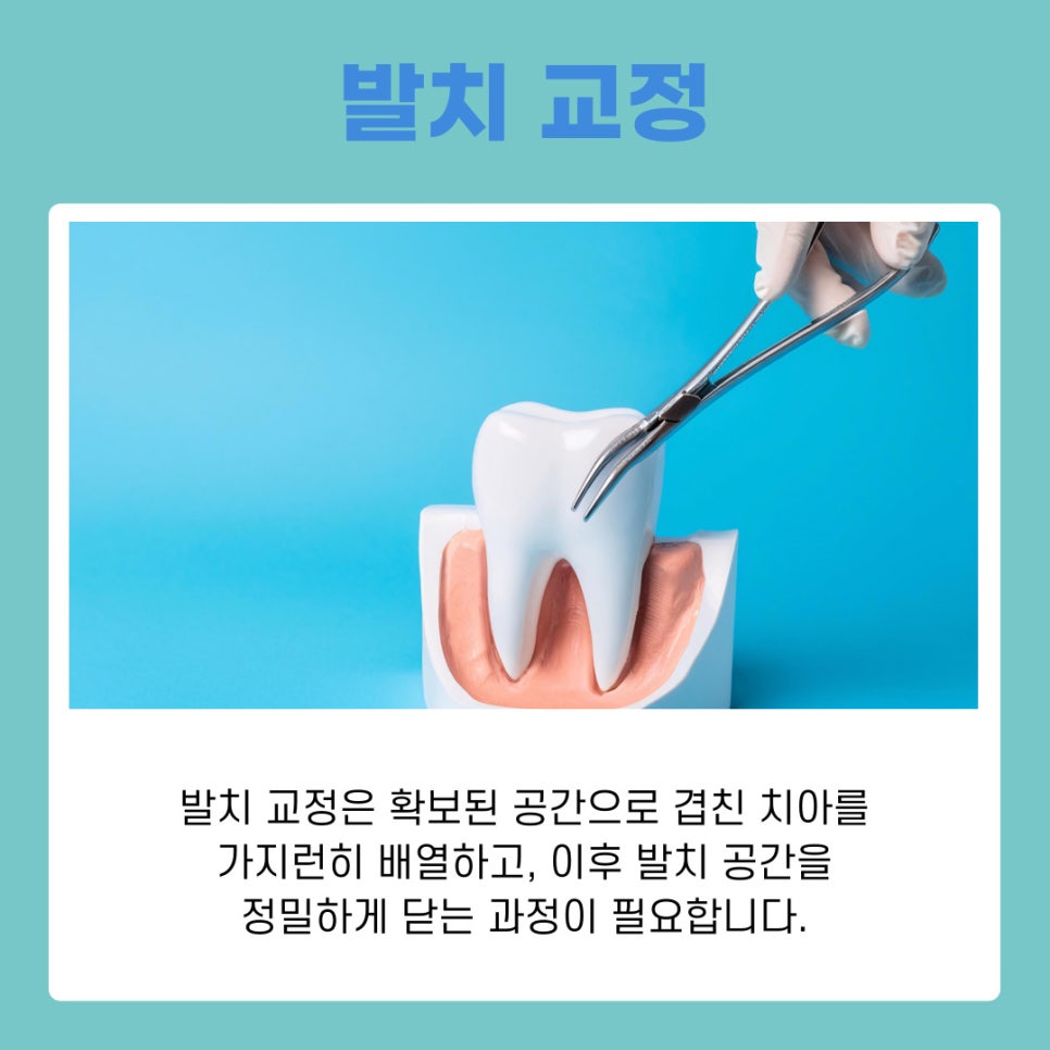 덧니 교정 발치 여부 어떻게 결정될까 관련 이미지 6