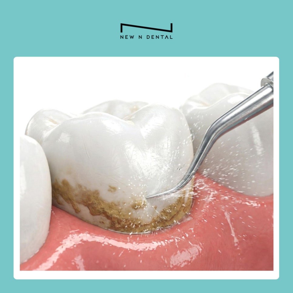 치아 건강의 핵심 서초역치과 연 1회 스케일링으로 치주염 예방 관련 이미지 5