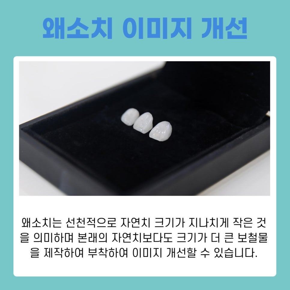 역삼동치과 라미네이트 하고 싶다면 어떤 점을 고려할까 관련 이미지 6