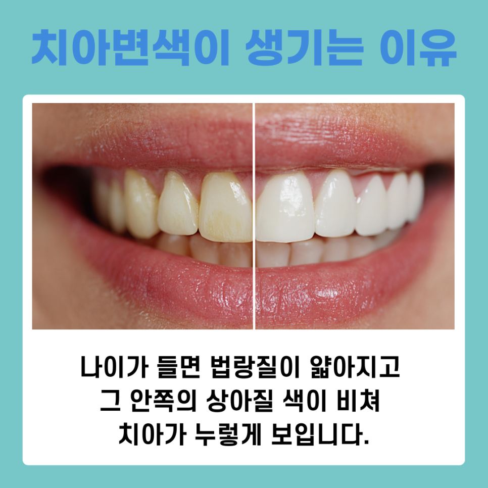 치아변색원인과 스케일링치료로 개선하는 방법 관련 이미지 4