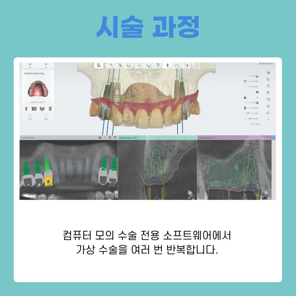 강남 디지털임플란트치과 시술 과정 총정리 관련 이미지 7