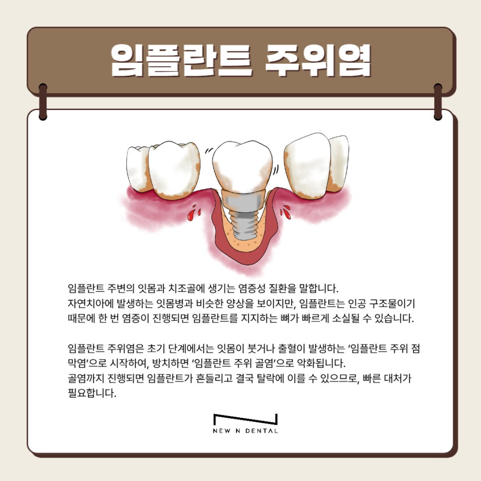 강남역 임플란트 치과 임플란트주위염 원인,증상,치료방법 관련 이미지 2