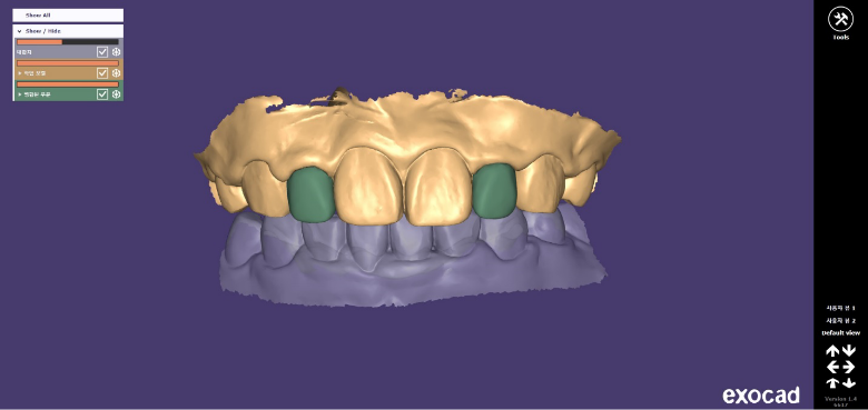 강남구라미네이트치과 튼튼하고 정교하게 관련 이미지 6
