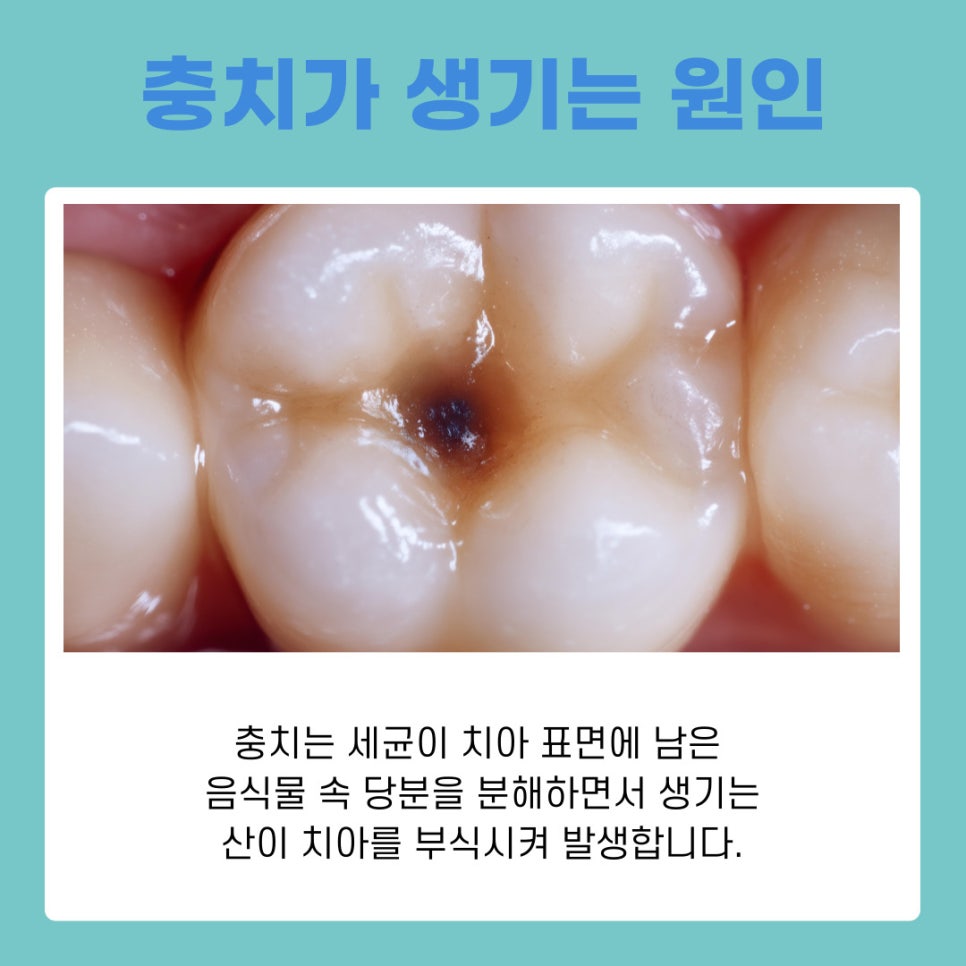 Seocho-dong Dental Clinic: Dental Regular Checkups and How to Prevent Cavities Properly image 5