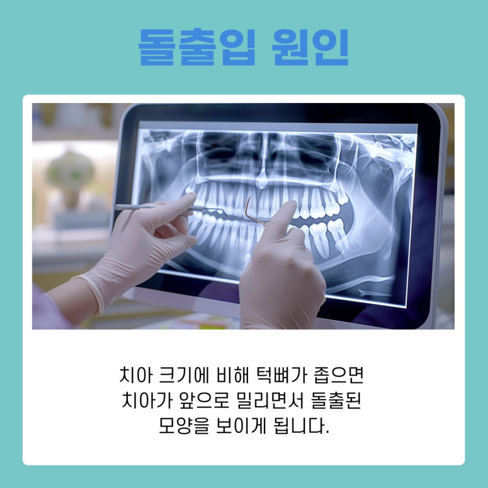 논현역치과 돌출입 치아 교정 비발치로 가능 할까? 관련 이미지 3