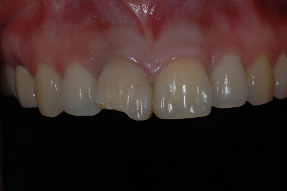 강남구라미네이트치과 튼튼하고 정교하게 관련 이미지 4