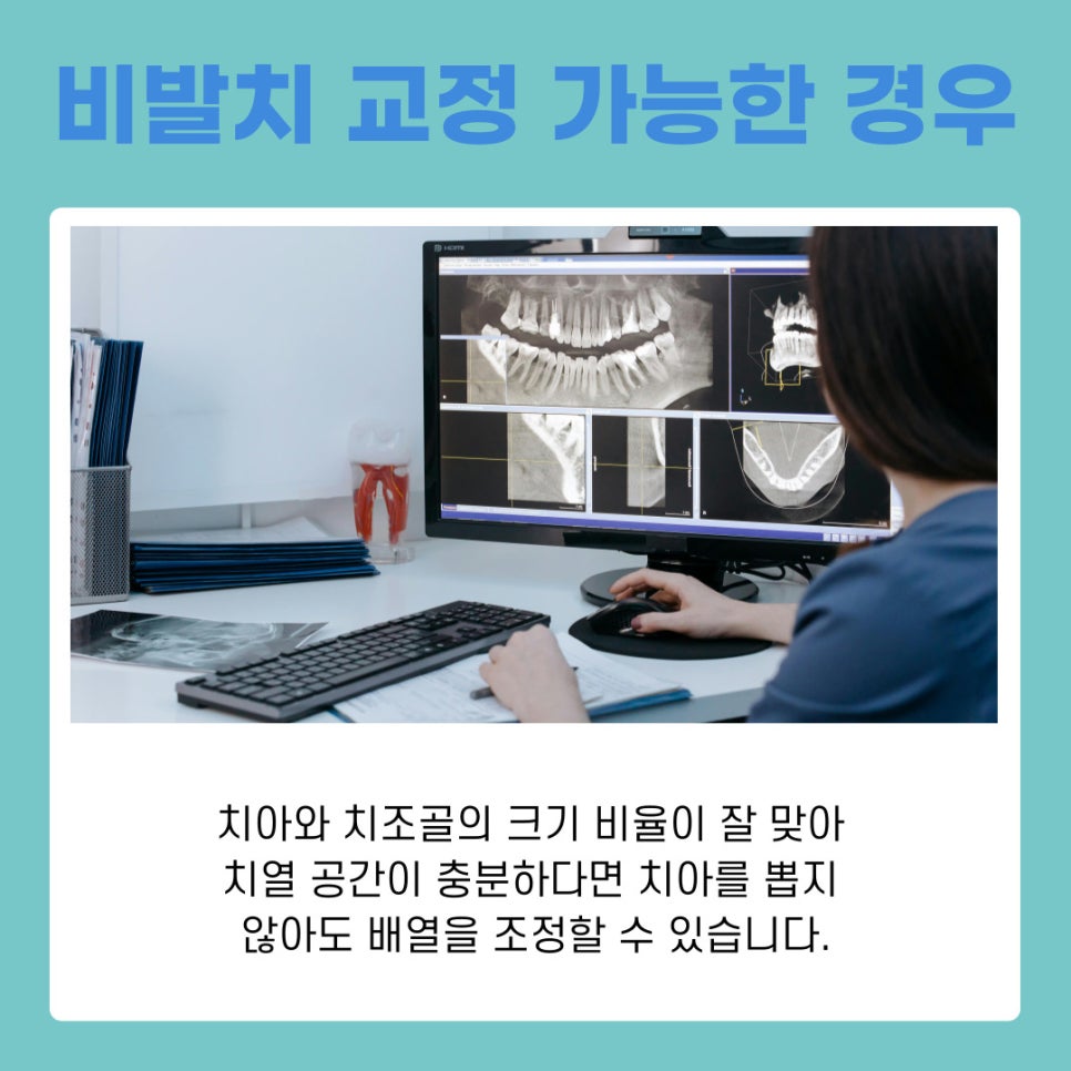 논현역치과 돌출입 치아 교정 비발치로 가능 할까? 관련 이미지 5