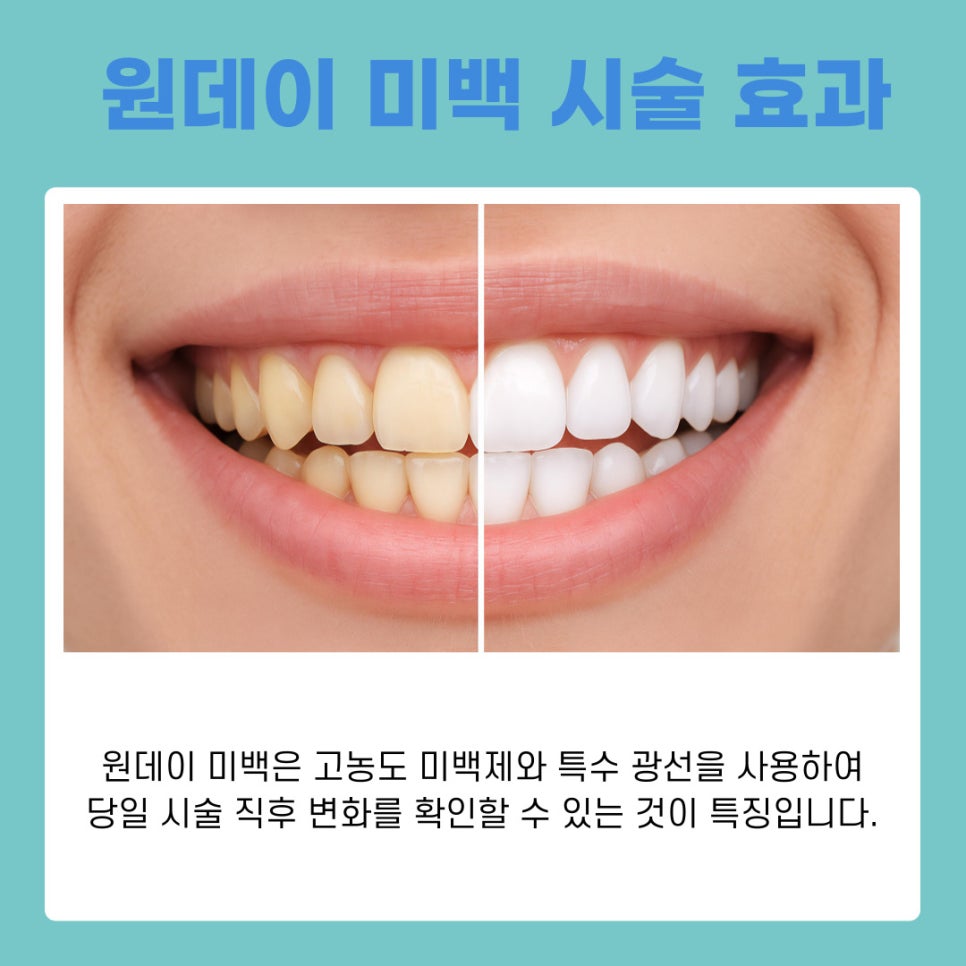 One-Day Teeth Whitening Procedure: A Bright Smile Completed in Just One Day image 11