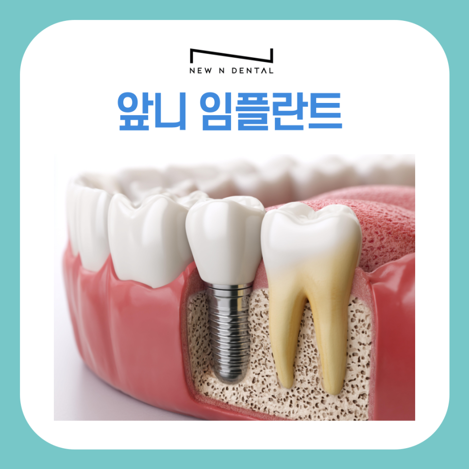 앞니 임플란트 식립 주의해야 할 사항은? 관련 이미지 2