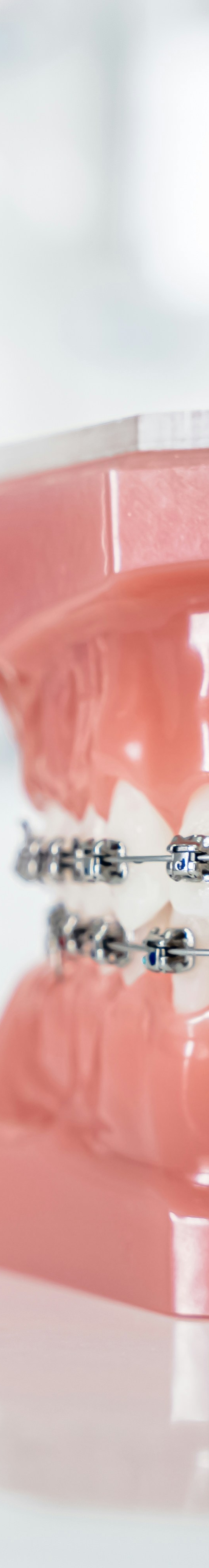 치아교정 종류 장단점 알아보기 관련 이미지 14