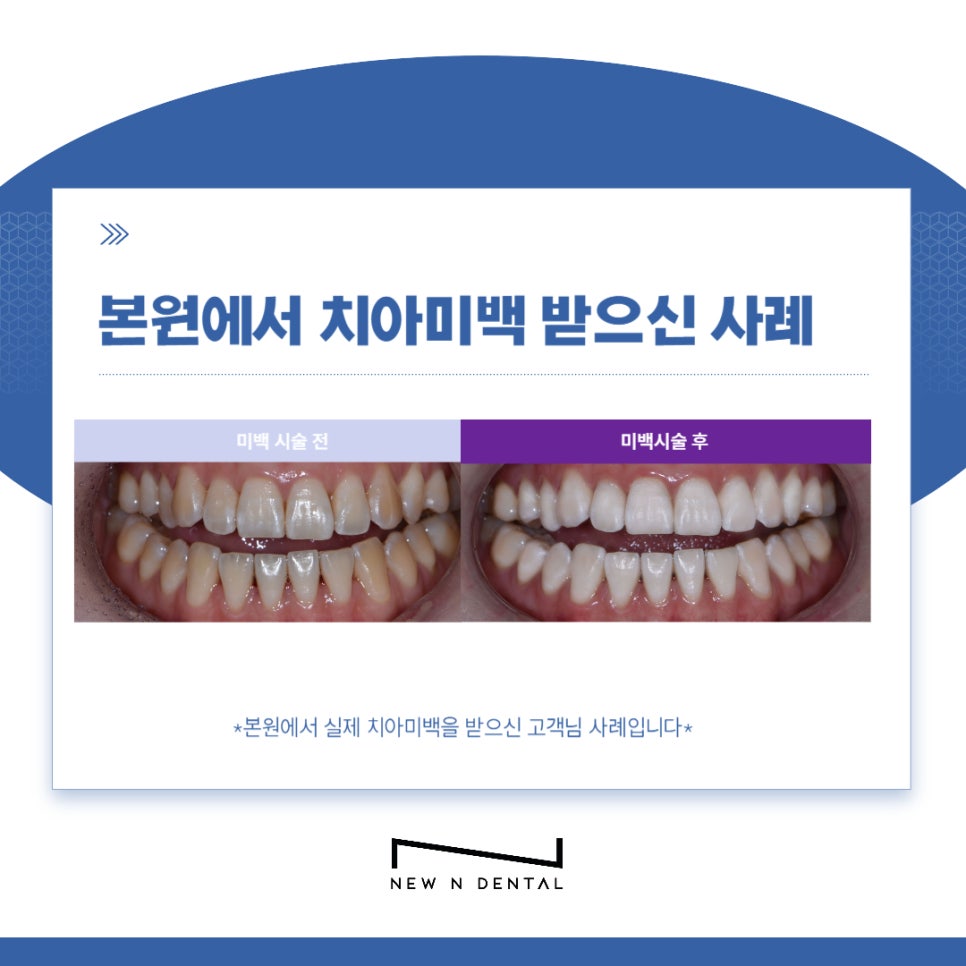강남치과 치아미백, 누런치아 하얗게 만드는 방법은 관련 이미지 6