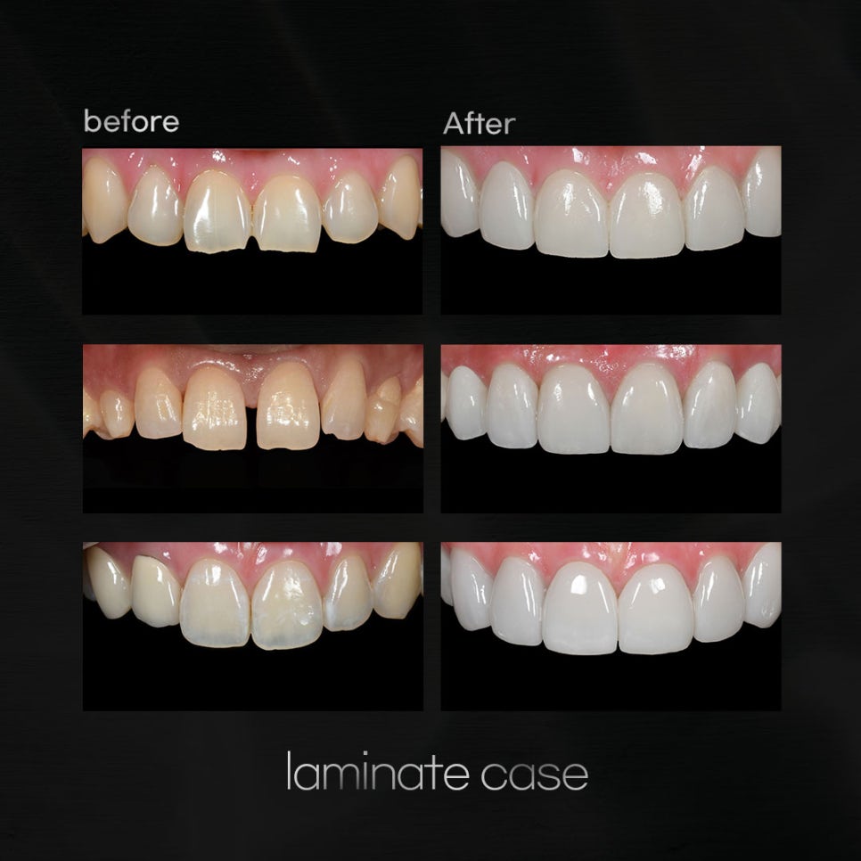 강남라미네이트 치료에 관한 심층적 이해와 고려 사항 관련 이미지 8