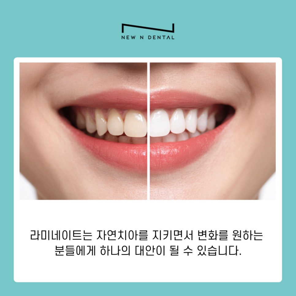 라미네이트 치아삭제 없이도 가능한 치아성형 알아보기 관련 이미지 9