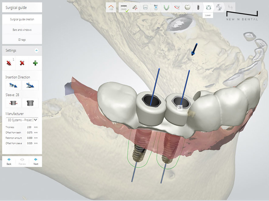 원데이 임플란트 빠르게 치료하려면 관련 이미지 4