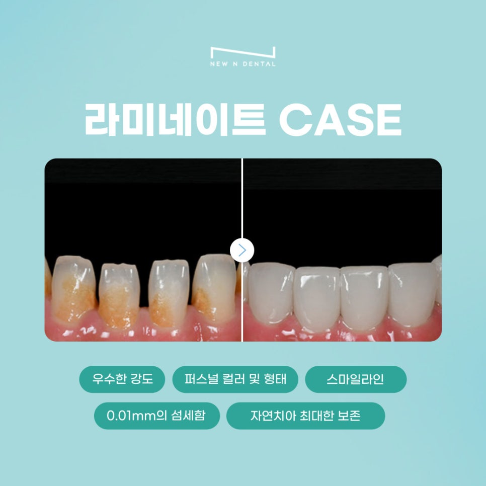 앞니심미치료로 되찾는 자연스러운 스마일 라인 관련 이미지 10