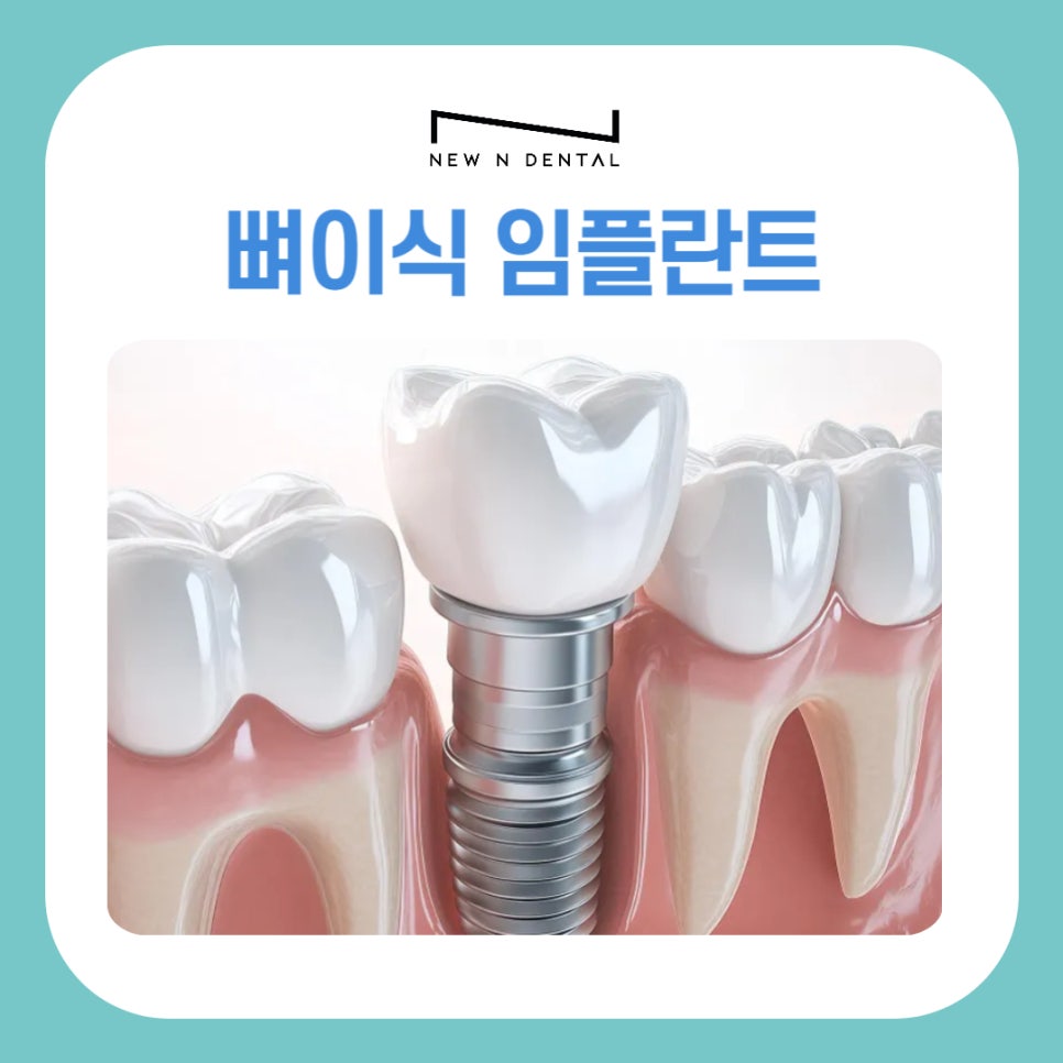 강남역 임플란트 뼈이식 잘하는 곳 뉴엔치과 관련 이미지 2