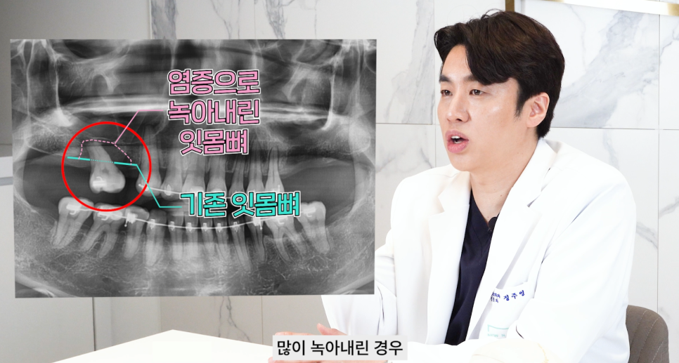 논현역치과 상악동거상술 어떤 치료일까 관련 이미지 7