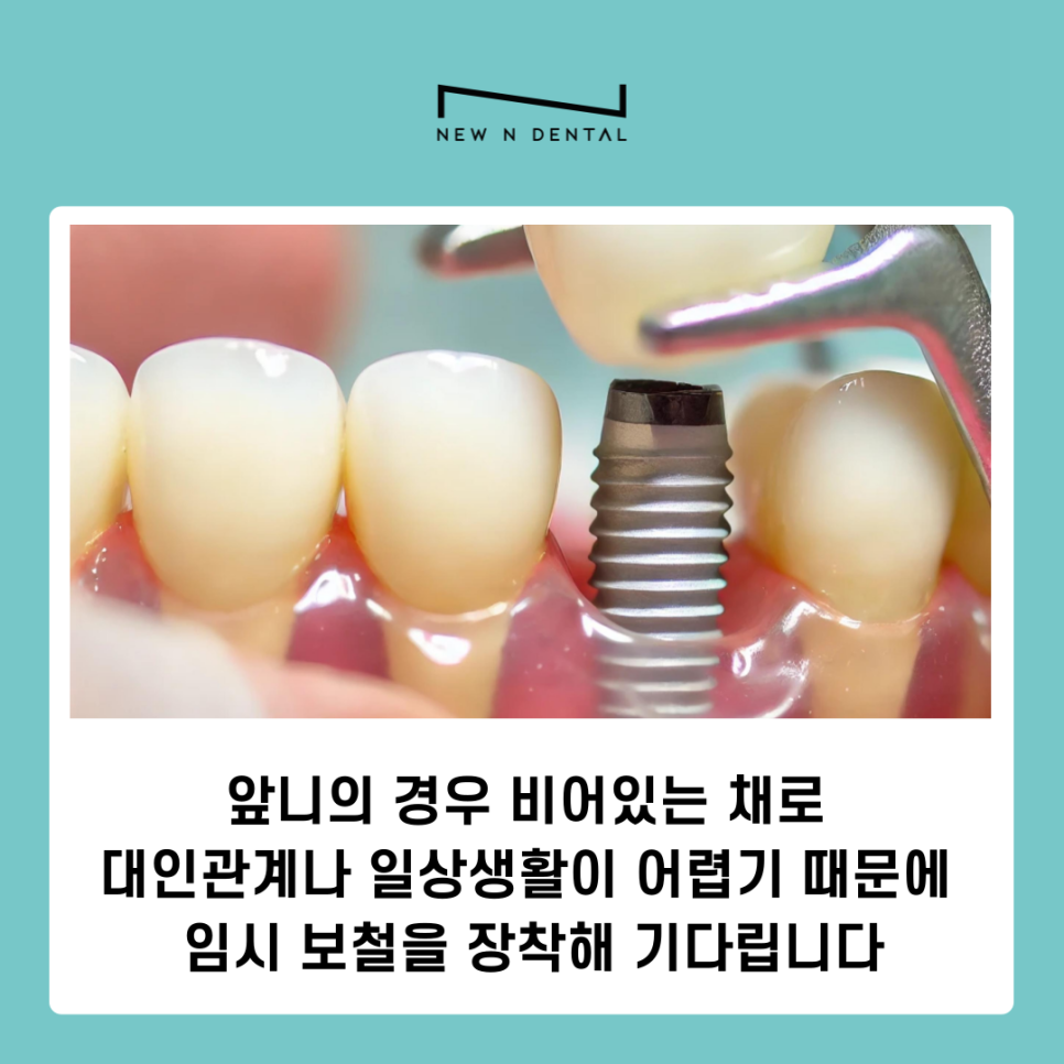 앞니 임플란트 식립 주의해야 할 사항은? 관련 이미지 7