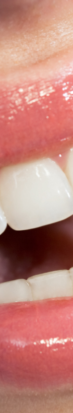 강남 무삭제라미네이트 치아깎지않는 개선방법 관련 이미지 12