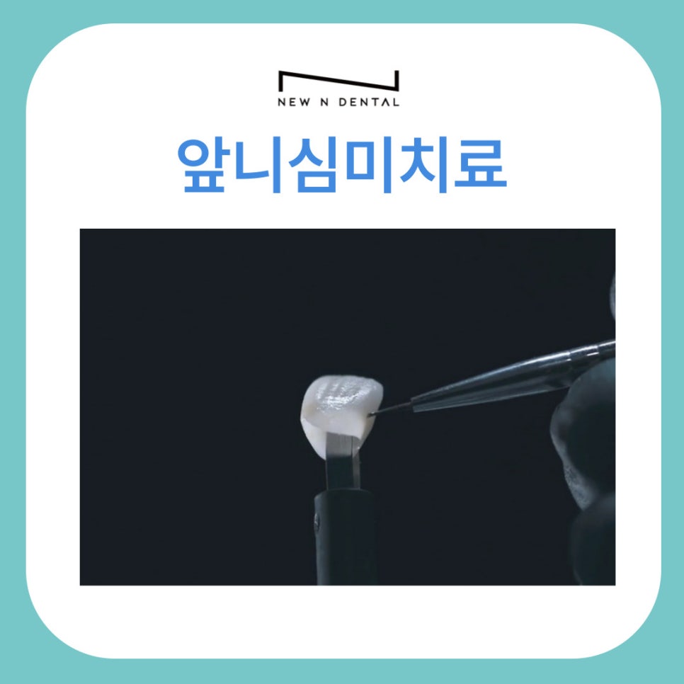 앞니심미치료로 되찾는 자연스러운 스마일 라인 관련 이미지 1